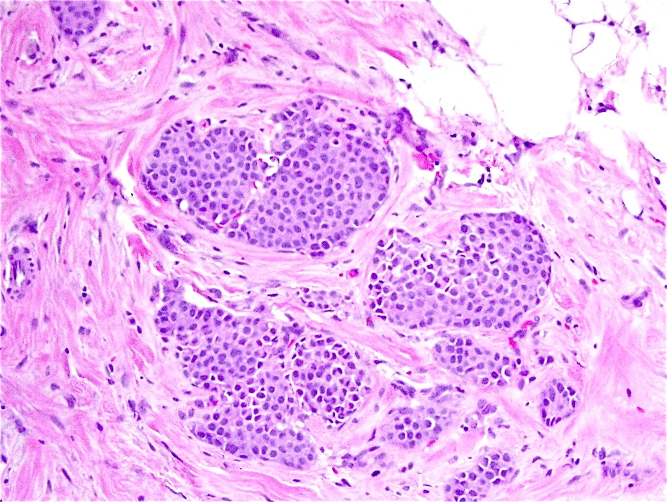 Ductal carcinoma in situ (DCIS)